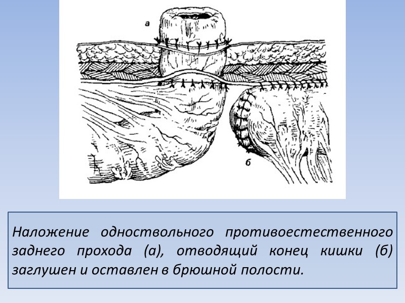 Наложение одноствольного противоестественного заднего прохода (а), отводящий конец кишки (б) заглушен и оставлен в